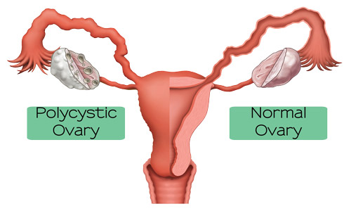 Polysystic Ovarian Syndrome (PCOS)