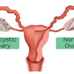 Polysystic Ovarian Syndrome (PCOS)