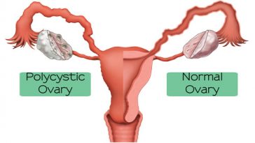 Polysystic Ovarian Syndrome (PCOS)